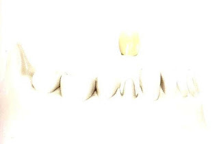 Coroa num dente natural