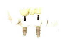 Ponte aparafusada sobre implantes
