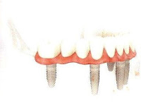 protese aparafusada sobre implantes