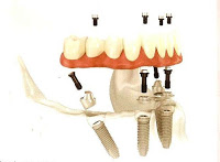 protese total aparafusada