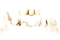 Pontes sobre dentes naturais